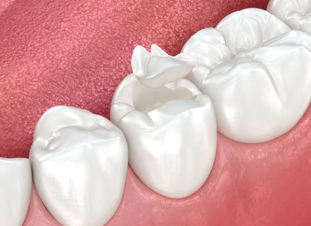 Best Dental Fillings (Composite and Amalgam)  in Cumberland Head, NY